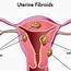 Uterine Fibroids Natural Treatment  YouTube