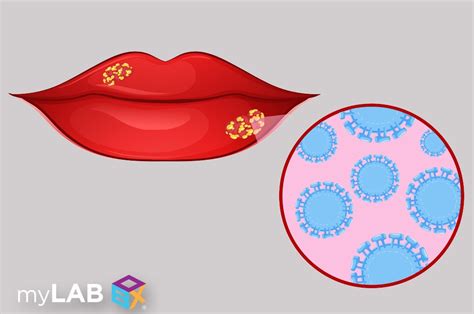Do Cold Sores Mean You Have An Std Std Testing Mylab Box™
