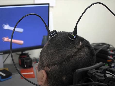 Paralysed Man Regains Feeling And Movement With Ai Brain Implant The