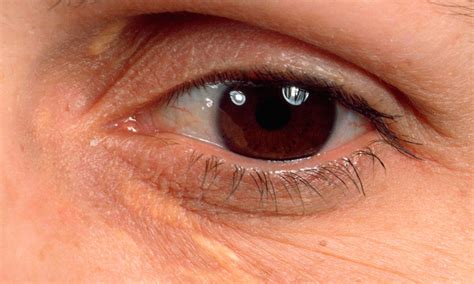 Yellow Eyelid Marks Xanthelasma Early Warning Sign Of Heart Disease