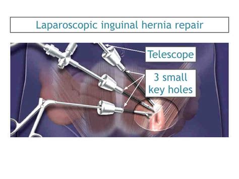 Inguinal Hernia Doctor Clinic Surgery Mumbai Laparoscopic Hernia Hot Sex Picture