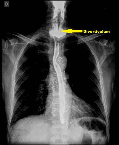 Diffuse Esophageal Spasm Differential Diagnosis Wikidoc