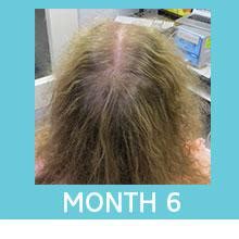 Amazon.com: Scalp Med Women's 4-month Re-growth Hair Kit ...