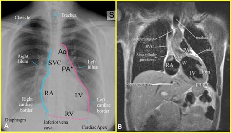 Chest X Ray Cardiac Anatomy And Pathology Correlation With Angiocardiography Ct And Mr