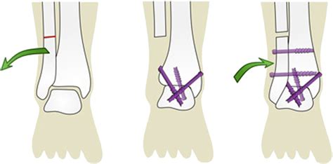 Figure 1 From Technical Guide Transfibular Ankle Arthrodesis With