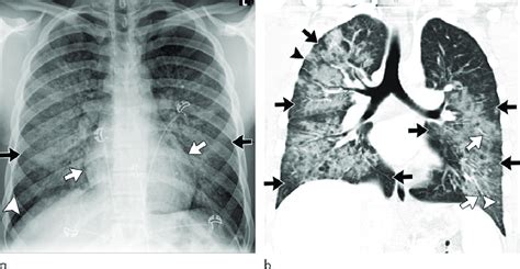 Images Show Electronic Cigarette Or Vaping Product Use Associated Lung