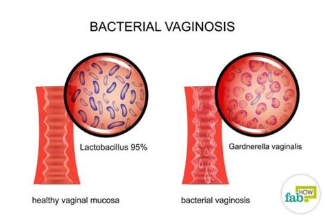 How To Get Rid Of Bacterial Vaginosis With Home Remedies