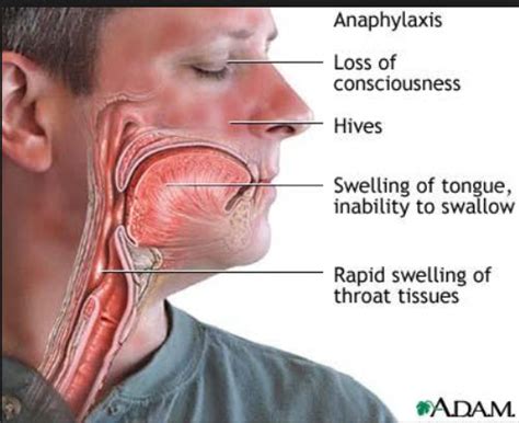 Maybe you would like to learn more about one of these? Anaphylactic Shock: Symptoms, Causes, And Treatments - CT ...