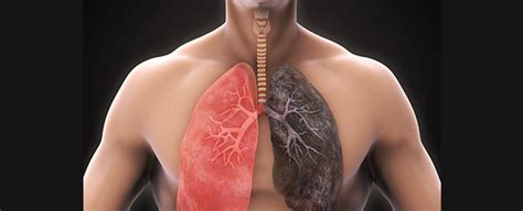 Diferencias Entre Bronquitis Y Enfisema Pulmonar