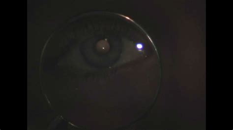 Retinoscopy Streak Simulated Myopia YouTube
