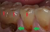 Images of Cupping Teeth Treatment