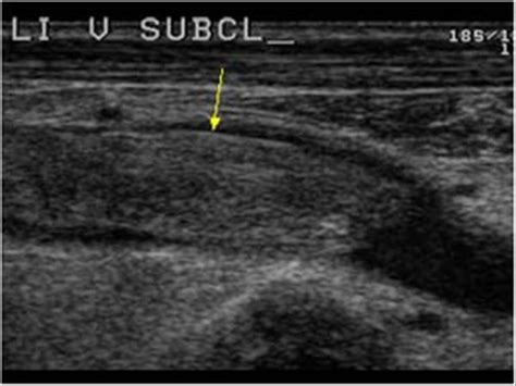 Ultrasound Upper Extremity Venous Anatomy