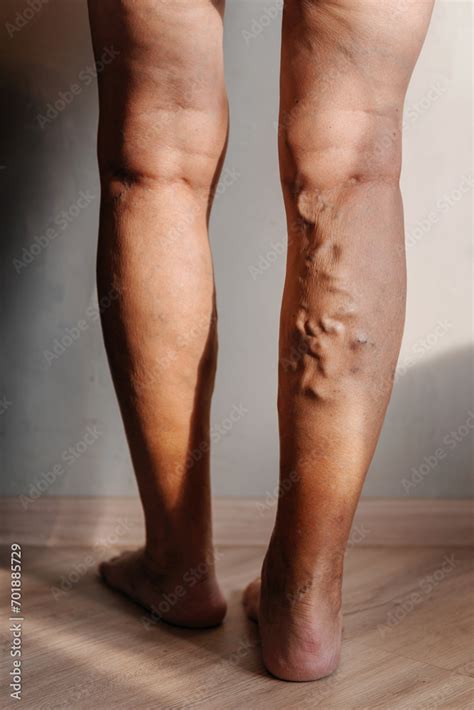 Varicose Veins In A Woman Swelling Of Veins In The Legs Of An Elderly