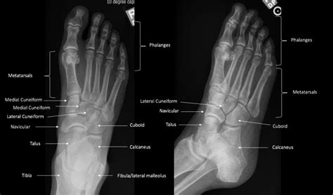 Anatomy Bony Pelvis And Lower Limb Foot Bones Statpearls Ncbi