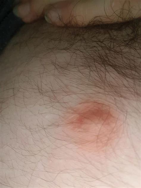 Had A Random Lump Spot Appear On My Chest Its Been Here For A Bit