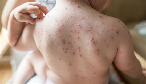 If You Had Chickenpox At Age 7 What Might Prevent You From Getting