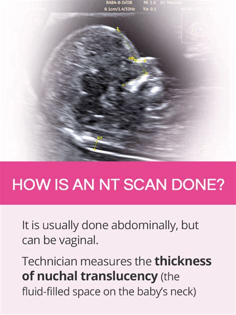 The nuchal translucency measurement can be taken during the dating scan. Nuchal Translucency | SheCares