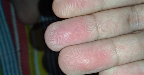 Swollen Finger Pads