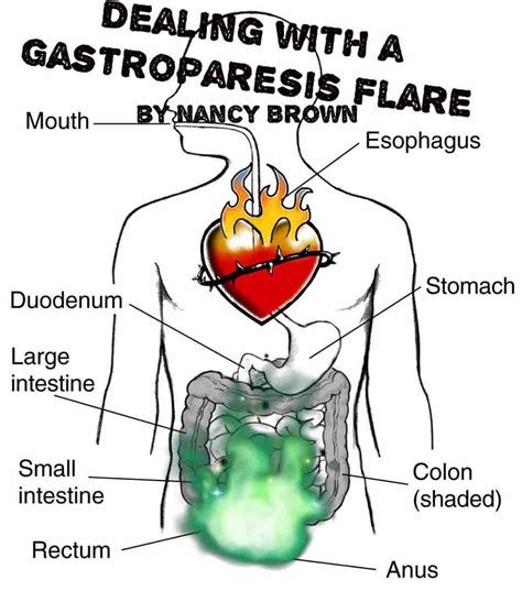 Dealing With A Gastroparesis Flare Gastroparesis Gastroparesis Diet