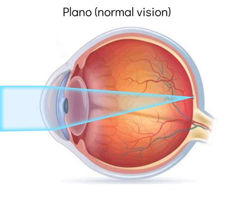 Short Sight Or Myopia What Is It And What Can You Do About It We