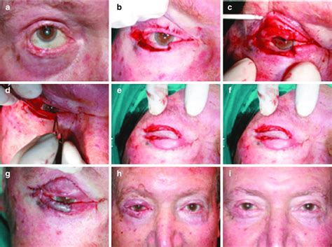 A I Large Lower Eyelid Defect Repair Using Lateral Based