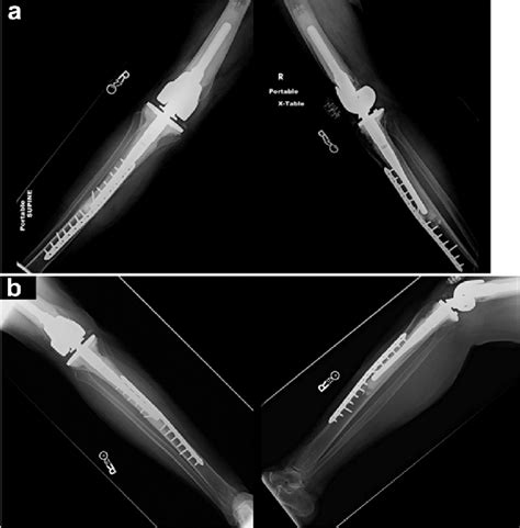 Post Operative Radiographs Of Right Tibial Reconstruction A Showing