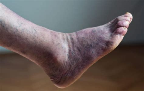 Blue Discolored Feet What You Should Know Usa Vascular