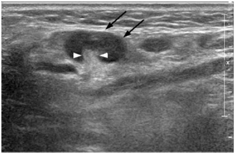 In The Normal Neck Using High Resolution Ultrasonography About 90 Of