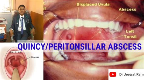 Incision And Drainage Of Perirectal Abscess Cpt Code