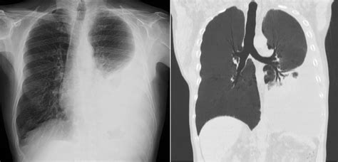 Do Bilateral Pleural Effusions Always Have The Same Cause
