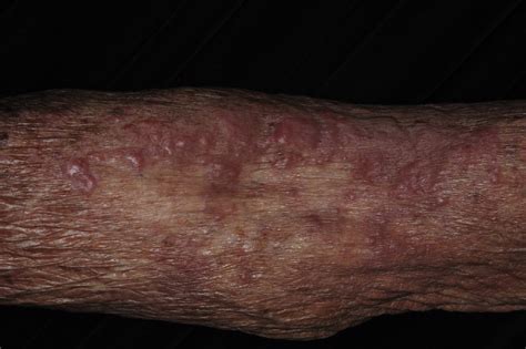 Scattered Erythematous Indurated Papules And Plaques On The Right Arm