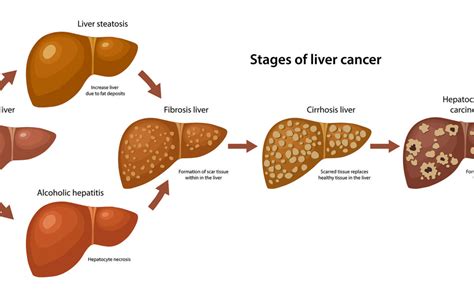 Stages Of Liver Cancer Cyberknife Treatment Center Miami