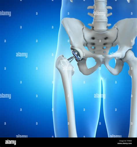 3d Rendered Illustration Of A Hip Implant Stock Photo Alamy