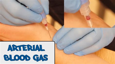 Arterial Blood Gas Sampling Abg Osce Guide Youtube