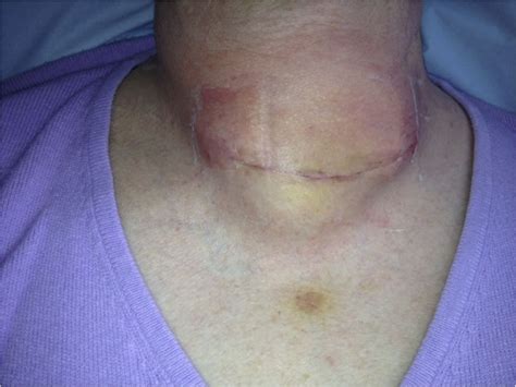 Neck Swelling After Thyroidectomy Not Always A Haematoma Bmj Case Reports