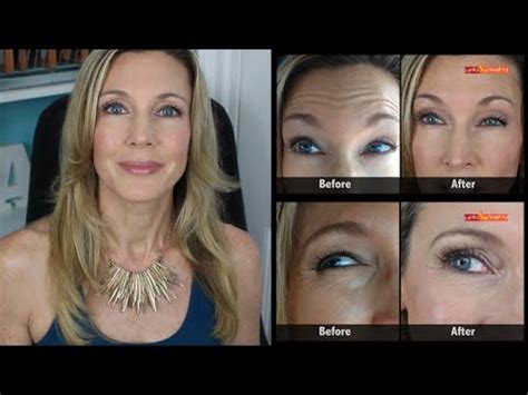 The first thing you'll notice immediately after botox injections are little bumps and dots of blood that look just like mosquito bites. Botox Results Mature Skin | Crows Feet & Forehead Wrinkles ...