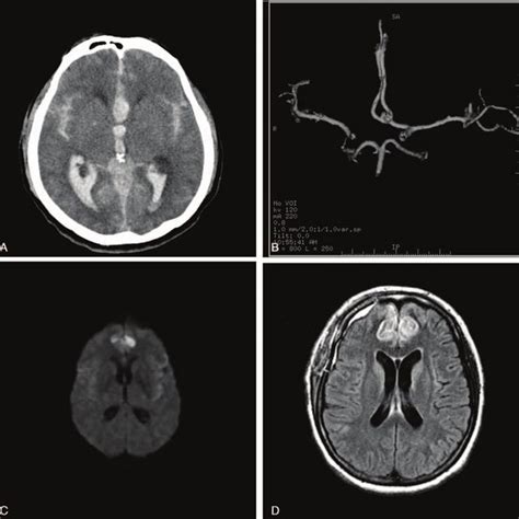 A Brain Ct Scans On Admission Showed A Thick Subarachnoid Hemorrhage