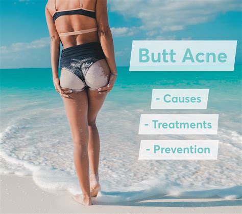 How To Get Rid Of Pimples On The Butt Mdacne