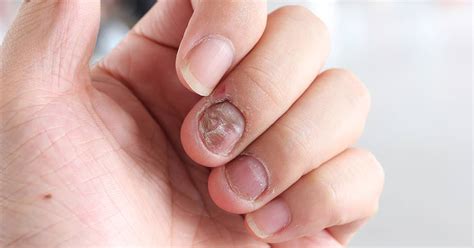 Dyshidrotic Eczema Fingernails Nail Ftempo