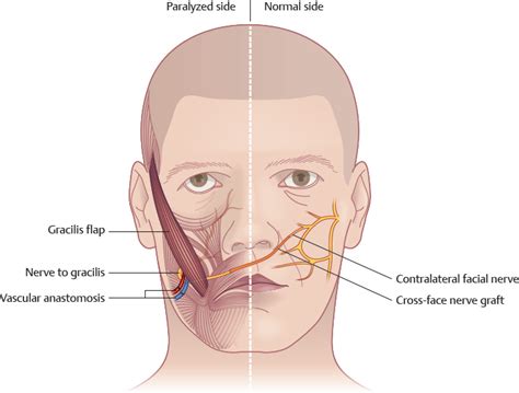 Facial Reanimation Surgery Plastic Surgery Key