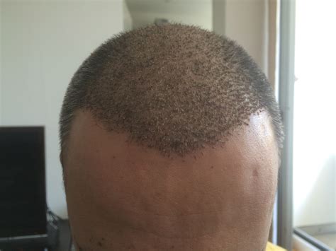 We did not find results for: Haartransplantation Forum : Erfahrungsberichte ...