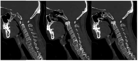 Leiomyosarcoma Metastatic To The Cervical Spine Causing A C6