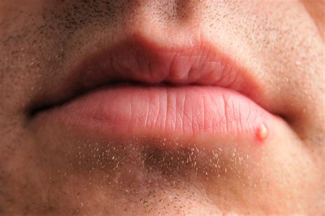 How To Identify A Herpes Cold Sore Vs Pimple — Expert Advice Tracost