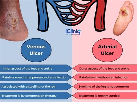 Arterial Vs Venous Ulcers What Are The Differences Sexiz Pix My XXX