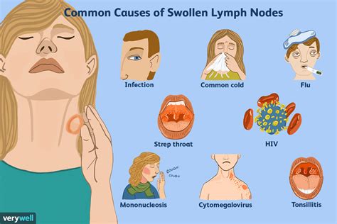 How To Tell A Lump From A Lymph Node Swollen Lymph Nodes Lymph Nodes