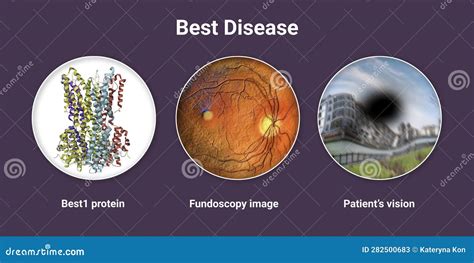Best Disease Best Vitelliform Macular Dystrophy Illustration Stock