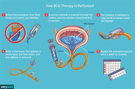 Bcg Treatment For Bladder Cancer What You Need To Know