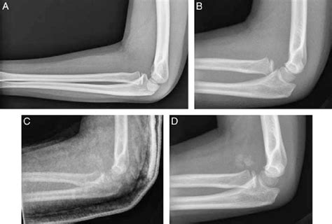 A Anterior Radial Head Dislocation With Plastic Deformation Of The