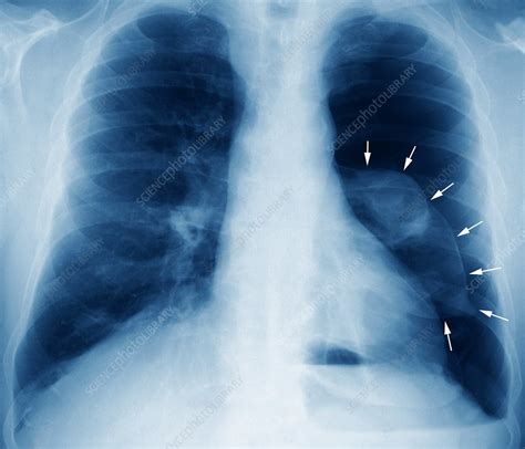 Pneumothorax X Ray Stock Image M2400653 Science Photo Library