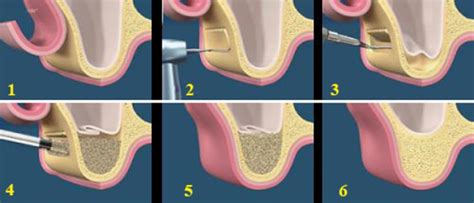 Sinus Lift When Have Dental Implantation